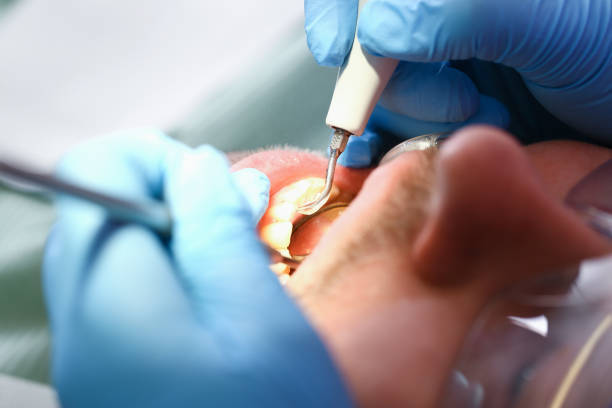 Best Emergency Root Canal Treatment in Mcconnelsville, OH