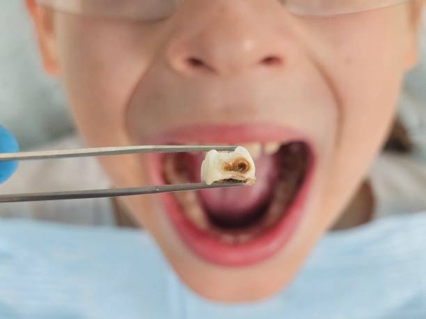Best Emergency Dental Care for Broken or Chipped Teeth in Mcconnelsville, OH